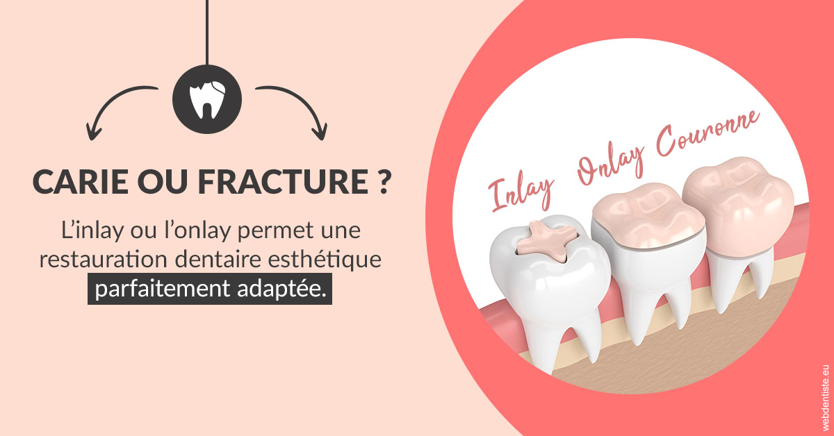 https://dr-cegarra-carolle.chirurgiens-dentistes.fr/T2 2023 - Carie ou fracture 2