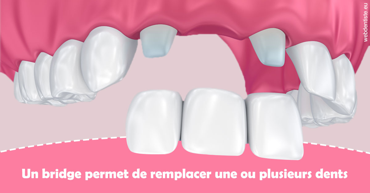 https://dr-cegarra-carolle.chirurgiens-dentistes.fr/Bridge remplacer dents 2