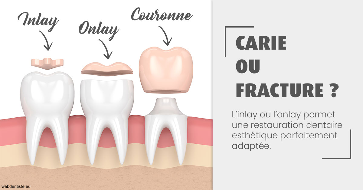 https://dr-cegarra-carolle.chirurgiens-dentistes.fr/T2 2023 - Carie ou fracture 1