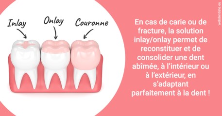 https://dr-cegarra-carolle.chirurgiens-dentistes.fr/L'INLAY ou l'ONLAY 2