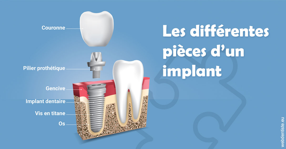 https://dr-cegarra-carolle.chirurgiens-dentistes.fr/Les différentes pièces d’un implant 1